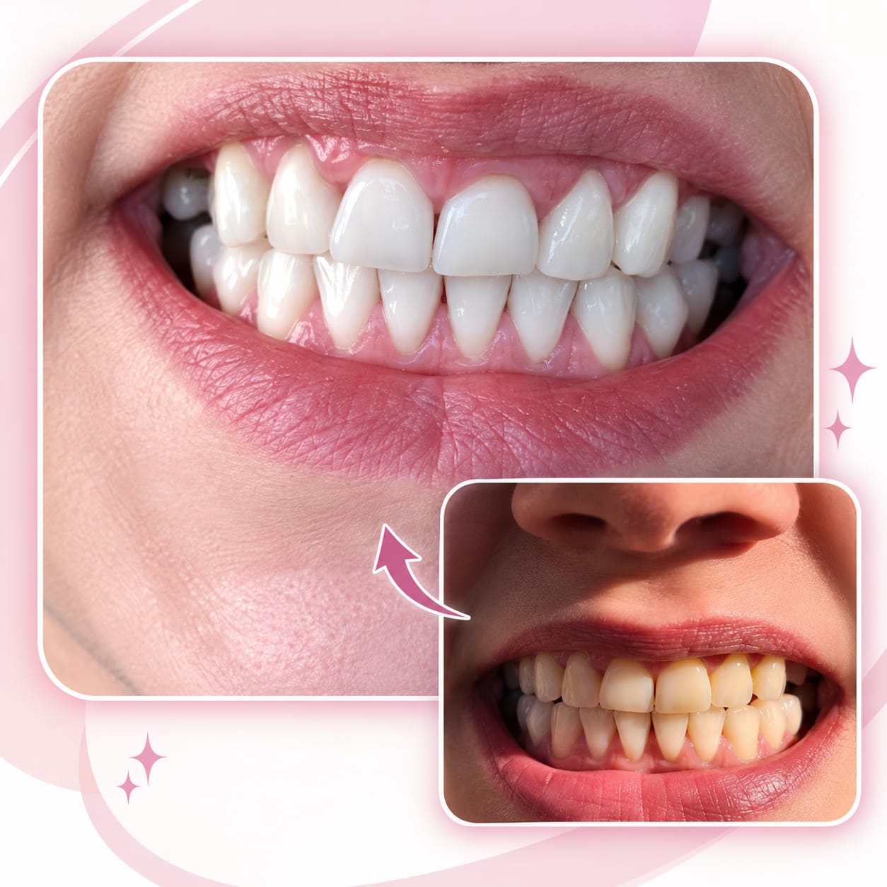 Sourires illustrant le blanchiment dentaire