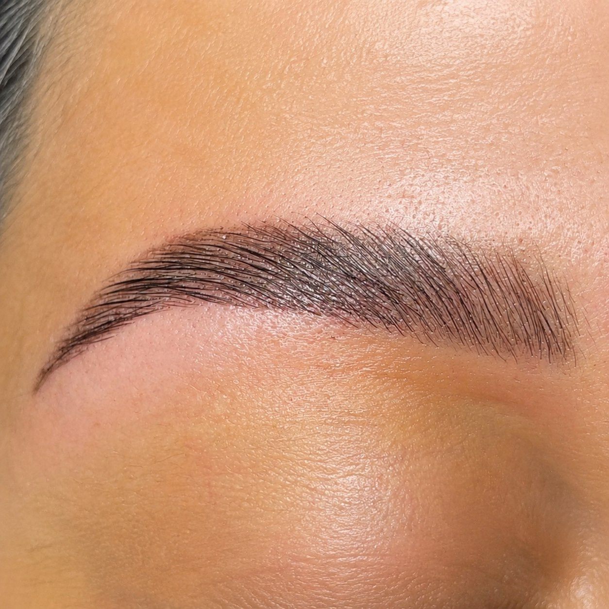 Brow lift